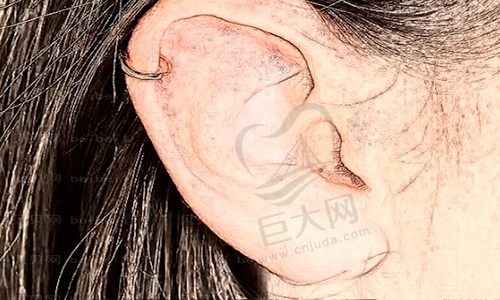 直埋法耳再造手术一期二期间隔多久?耳再造直埋一期术后图反馈