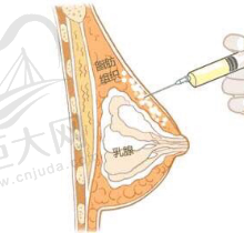 广州自体脂肪隆胸哪家医院好？听说曙光、美莱、军美脂肪丰胸出名