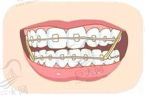 矫正的话牙齿先做咬合调整还是修复？牙齿咬合重建很痛苦吗