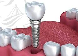 种植牙做完二期多久可以戴临时牙？种植牙的临时牙冠能坚持多久