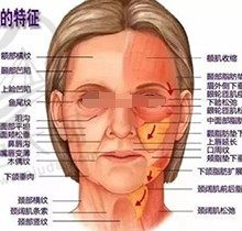 面部松弛做什么项目比较好？苹果肌下垂提升、法令纹改善解决办法