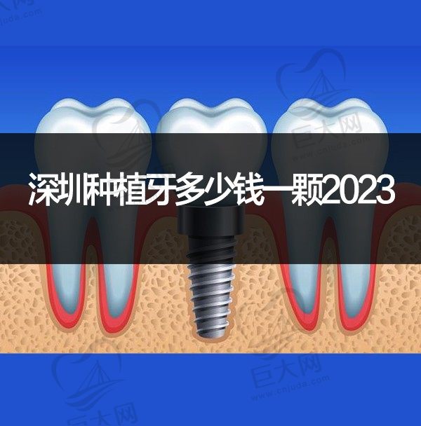 深圳种植牙多少钱一颗2023？听说4月20日起，深圳单颗种植牙总费用降逾50%