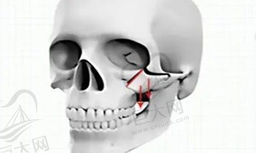 颧骨内推多少钱？颧骨内推需要开刀吗？分享颧骨内推手术全过程