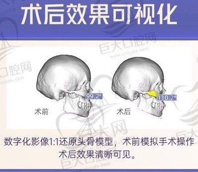 重庆做下颌角医院排名前三亮相，重庆做下颌角哪个医院做的好本文有