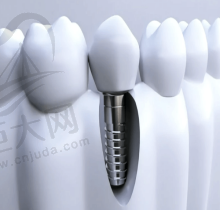 种植牙手术有几种方式？它们之间有什么区别？种牙后有什么注意事项