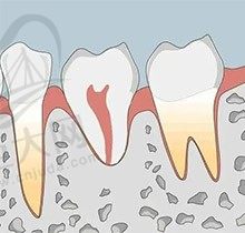 正畸牙根吸收是什么意思？出现牙根吸收后该怎么办？