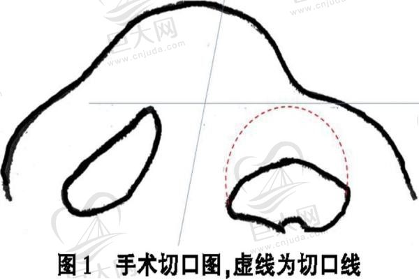 唇裂鼻子塌陷修复需要多少钱？查手术价格+医保报销医院医生