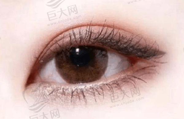什么是新型无痕双眼皮手术？它与传统双眼皮手术有什么区别