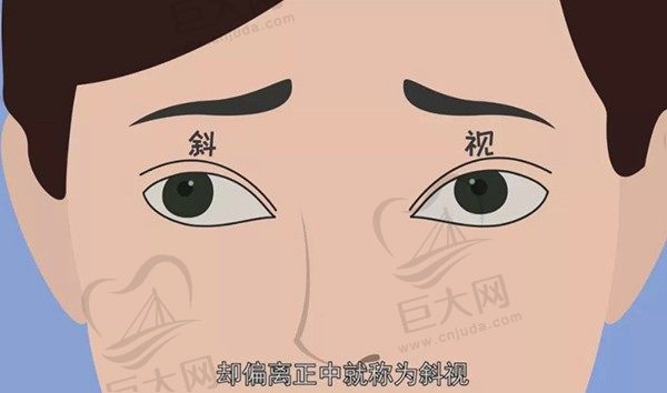 请问西京医院眼科斜视手术做的怎么样呢？斜视手术需要住院吗