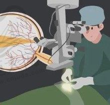 有人知道做完近视手术反弹的几率大吗？近视手术可以做二次吗？