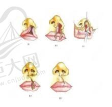 广州唇腭裂专家排名一览：广州唇腭裂修复较好医院医生都有谁
