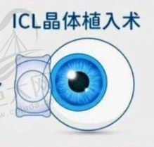 你知道为什么美国禁止ICL手术吗？这五类人千万别做ICL手术