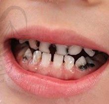 5岁小孩蛀牙已经烂空了怎么办？儿童牙齿龋齿补救方法有哪些