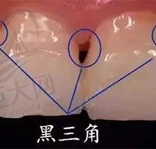 牙齿矫正出现黑三角正常吗？牙齿矫正黑三角怎么恢复？
