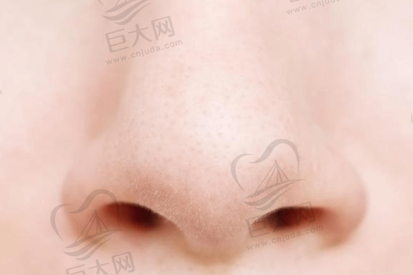 鼻翼缩小会反弹和留疤吗？鼻翼缩小手术内切和外切的区别是什么