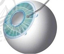 晶体植入和激光哪个危害更大？请问晶体植入近视眼手术有什么后遗症？