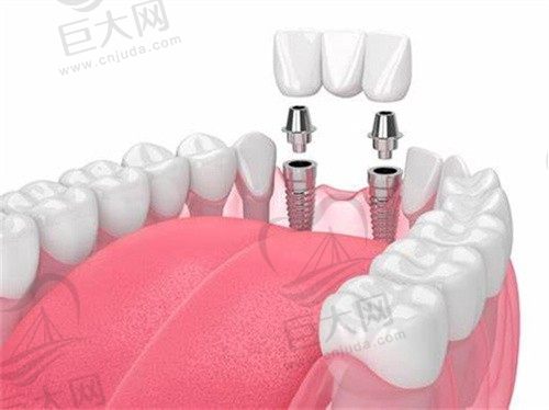 云南昆明柏德口腔Schahram医生德国BEGO种植牙8800元起，种牙效果好