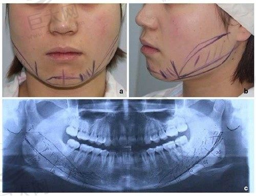何照华医生做下颌角手术好吗？3D再造术打造精致小V脸，找何医生很靠谱