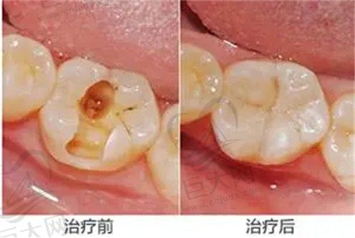 太原鼎植口腔医院李艳楠儿童蛀牙500元起，解决蛀牙牙痛效果很不错