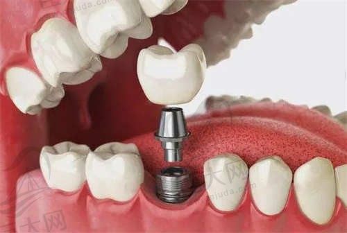 西安奈森卡口腔种植牙6456元，数字化种植定位更精准，创伤更小恢复快