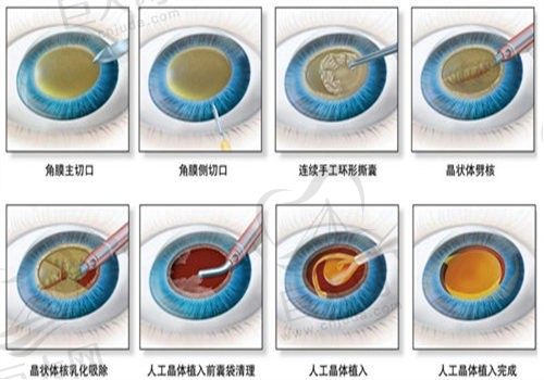 常州谱瑞眼科陈兵白内障手术8000元起，附详细价格清单可在线预约