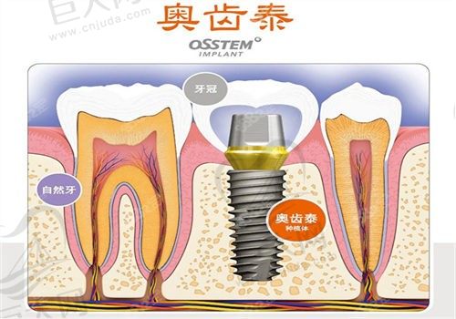 杭州修元口腔赵志楞奥齿泰种植牙3500/颗，价格亲民技术不错