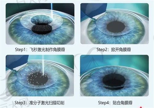 保定新视眼科医院申文辉全飞秒10979元起，医生评价、实例分享