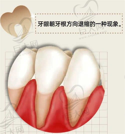 关于牙龈萎缩和牙根外露的原因有哪些？会出现哪些症状