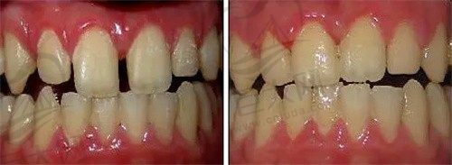 牙缝大怎么修复最好?修复后的注意事项有哪些？
