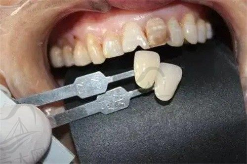 镶牙时两边所磨的牙会缩短寿命吗?如何选择合适的修复方案