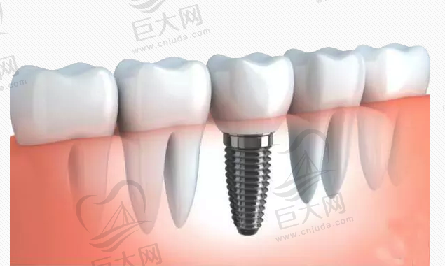 种植牙示意图