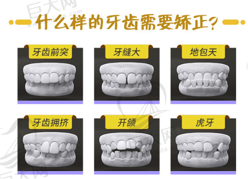 什么样的牙齿需要矫正