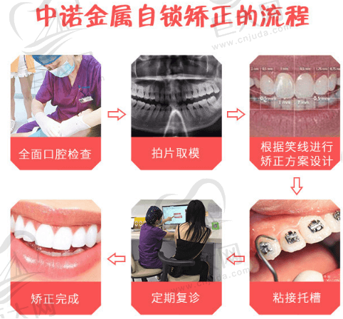 中诺口腔矫正流程