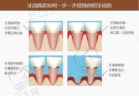 牙周病