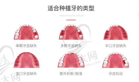 适合种植牙的类型
