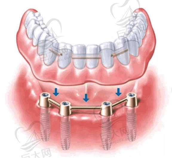 合肥美奥口腔ALL-ON-4全口种植牙