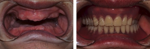 合肥美奥口腔陈国庆院长做的ALL-ON-4全口种植牙案例效果图