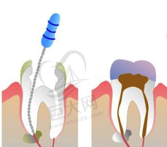 根管治疗示意图