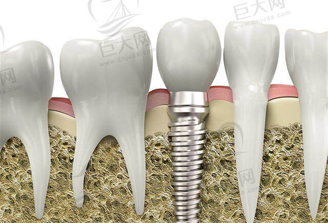 种植牙示意图