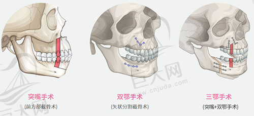 凸嘴怎么改善