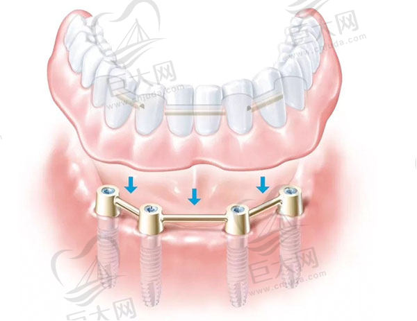 all-on-4种植牙