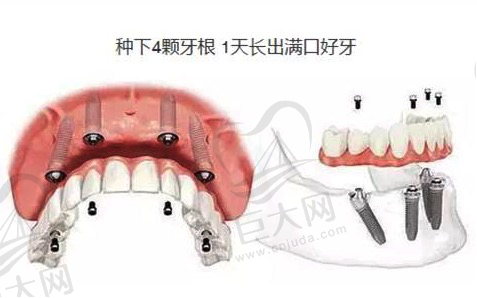 成都锦江极光口腔的王凌成院长在ALL-ON-4全口种植牙怎么样？