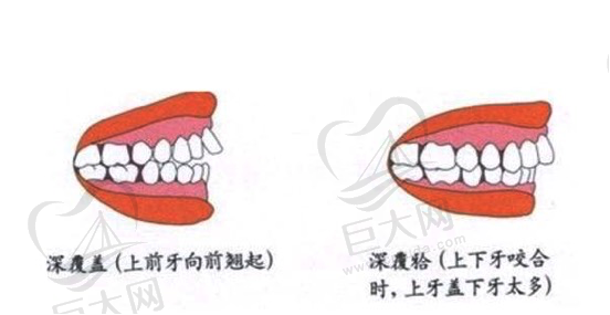 牙齿深覆合和深覆盖区别