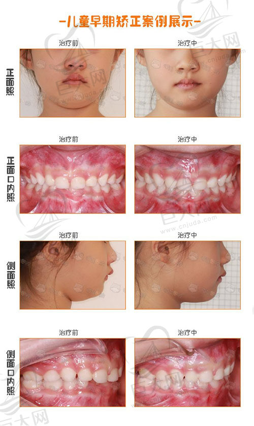 成都河马口腔儿童深覆合早期矫治案例