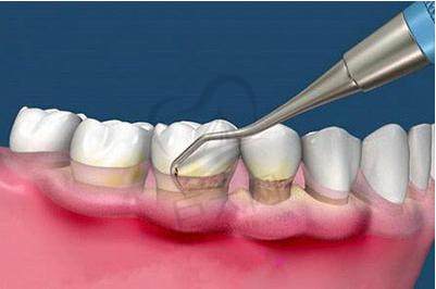 龈下刮治术示意图