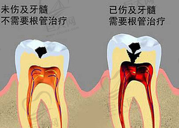 牙髓病是牙髓组织的疾病