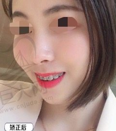 李勇医生矫正牙齿后