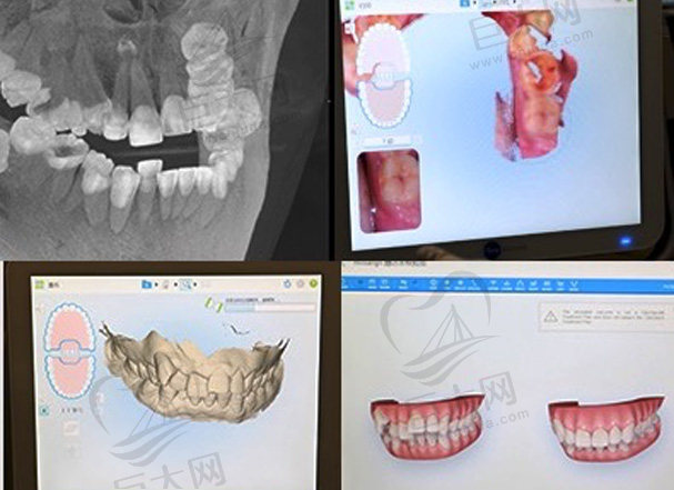 深圳福华口腔医院数字化矫正技术