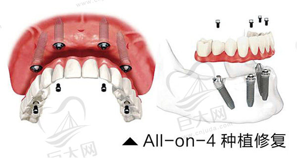 all-on-4种植技术