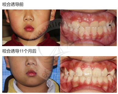  7岁5个月男童罗慕咬合诱导系统反颌矫正对比图